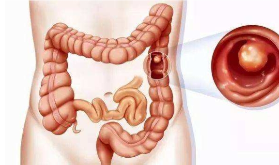 急性肠胃炎位置图片