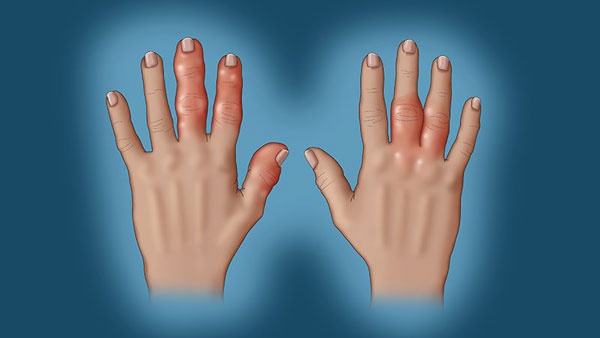 这种慢性炎症性疾病通常首发于手指和脚趾关节,造成关节肿痛,影响关节