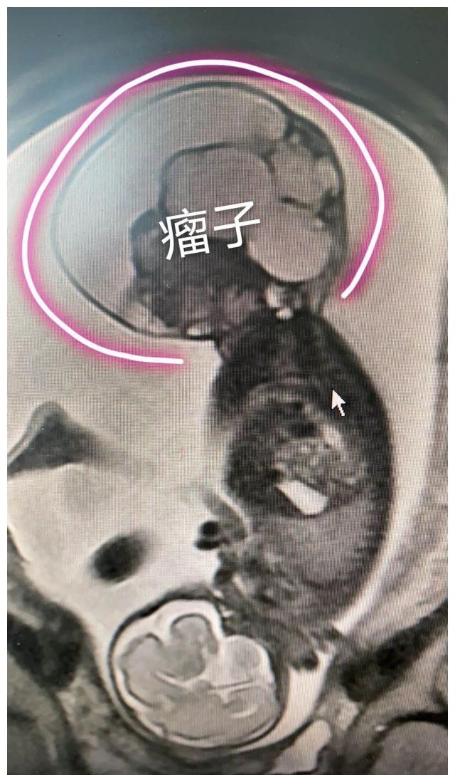 但是问题出在,这个畸胎瘤的生长速度太快了,30 周左右的磁共振显示