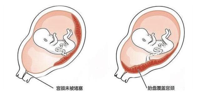 有的孕妇是前置胎盘,有的是后置,这也会在一定程度上影响孕肚的大小