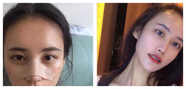 捏鼻子鼻梁会变高吗？如何正确提高鼻梁？