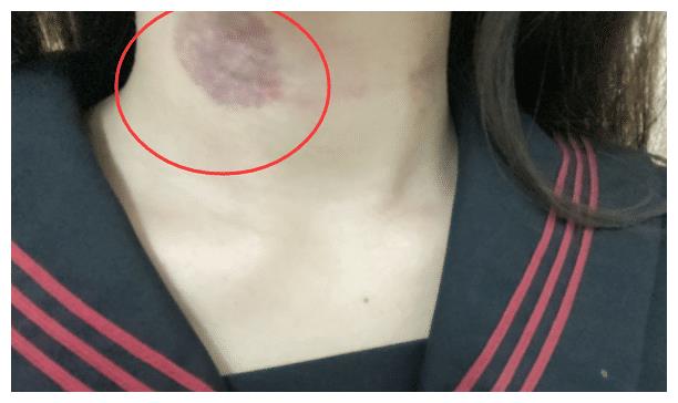 居然能在脖子上吸这么大的一颗草莓,现在的妹子真得悠着点儿,学医狗