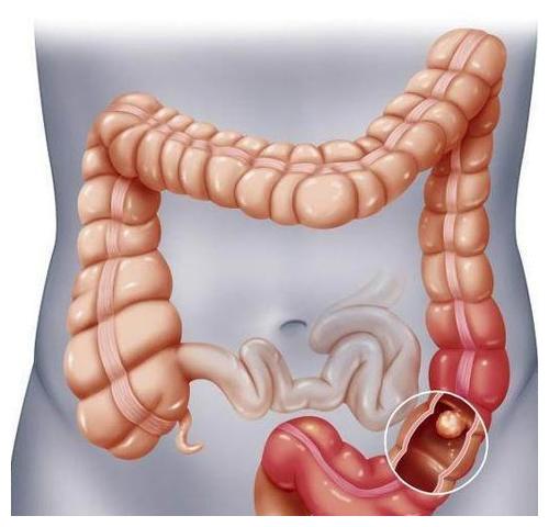 刚吃完饭就想大便或并不是因为直肠子这几个原因要注意
