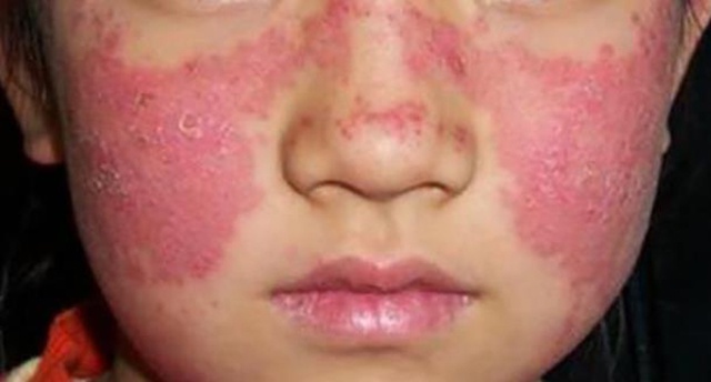 系统性红斑狼疮女性能否怀孕