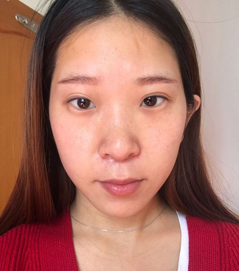 发际线有痣,感情不好,与亲人关系淡薄,得不到关爱