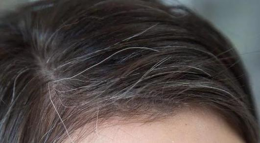 以上这些方法不一定能让已经变白了的头发变黑,但有可能防止白