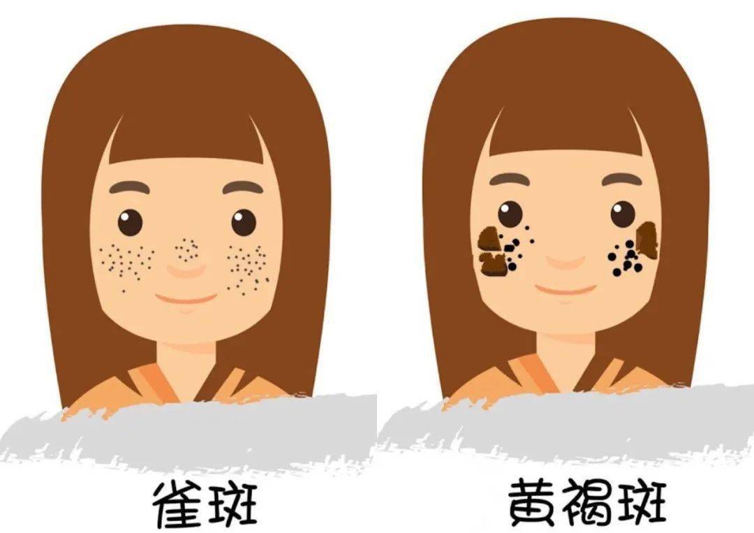 号称斑中之王的黄褐斑究竟该如何对它