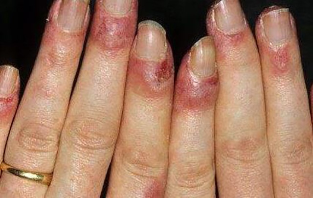 系统性红斑狼疮女性能否怀孕