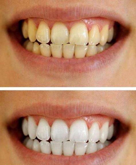 被俄罗斯"忽视"牙膏火了,用后牙黄牙渍消失了,笑容