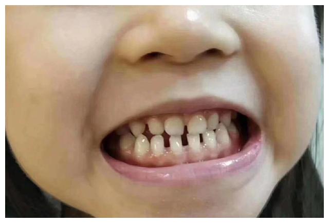 整牙医生最喜欢的乳牙却被网友说太难看什么乳牙算是好的呢