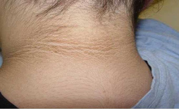 黑棘皮病,常见于颈部,腋窝等容易发生摩擦的部位,表现为天鹅绒样的