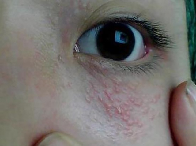 眼影表面小颗粒像鸡皮疙瘩(眼睛周边有很多小疙瘩粒像鸡皮) 眼影表面小颗粒像鸡皮疙瘩(眼睛周边有很多小疙瘩粒像鸡皮)