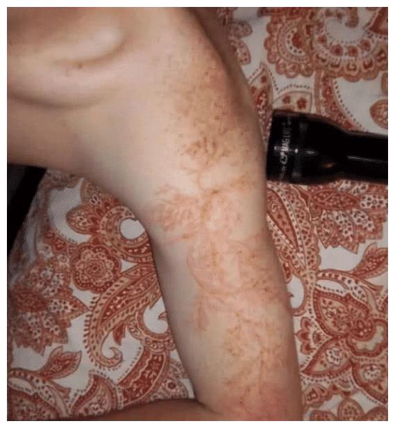 被击中者能活下来,不过,这个时候,幸存者的身上就会留下这样一些疤痕