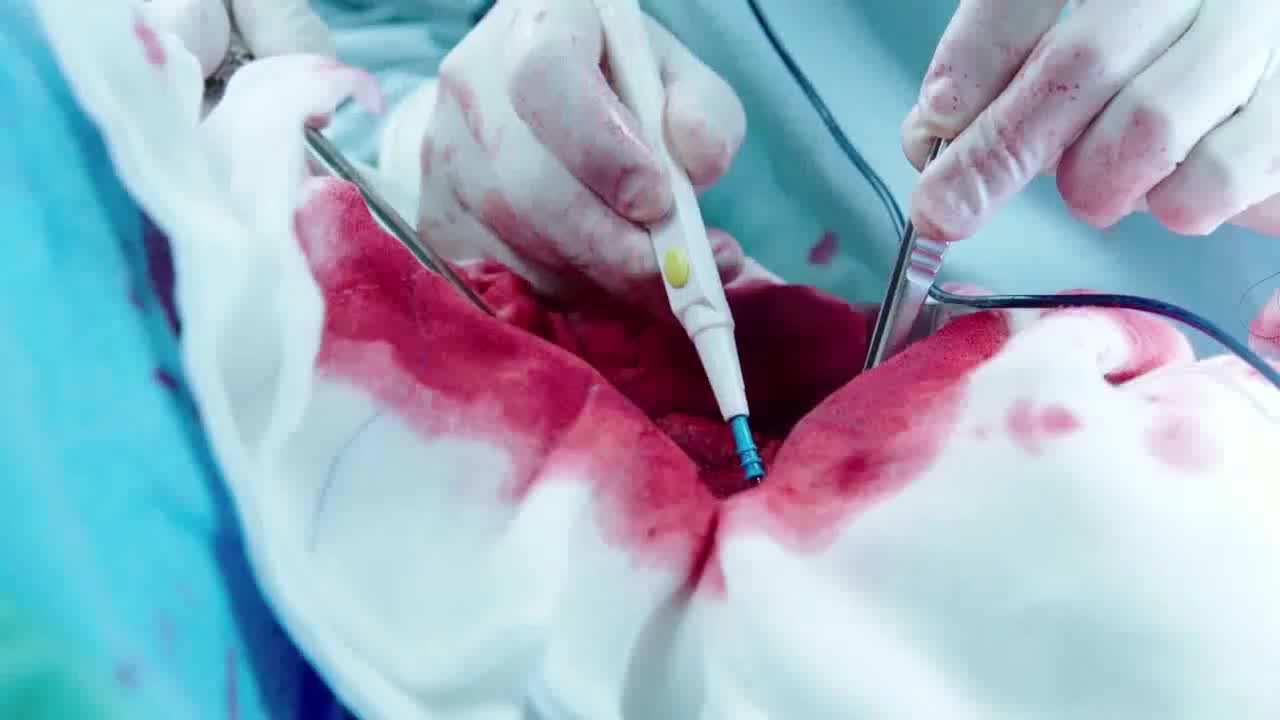 女医生手术台上出现重大失误,瞬间被喷一脸血,主刀医生紧急挽救