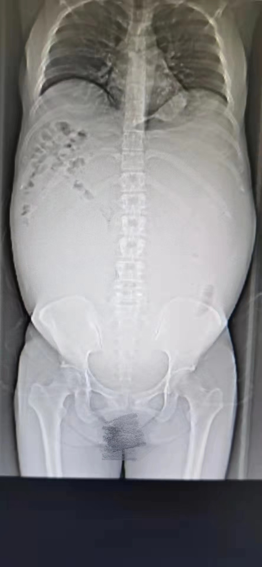 澳门女子突然肥胖 不是怀孕、减肥不见效是体内长了21斤重的肿瘤休闲区蓝鸢梦想 - Www.slyday.coM 澳门女子突然肥胖 不是怀孕、减肥不见效是体内长了21斤重的肿瘤休闲区蓝鸢梦想 - Www.slyday.coM