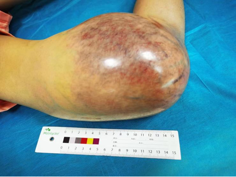 很多孩子在生长发育期,突然出现骨关节疼痛,局部肿块,运动障碍.