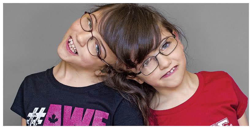 连体人大揭秘2个大脑控制同一个身体一个去世另一个还能活