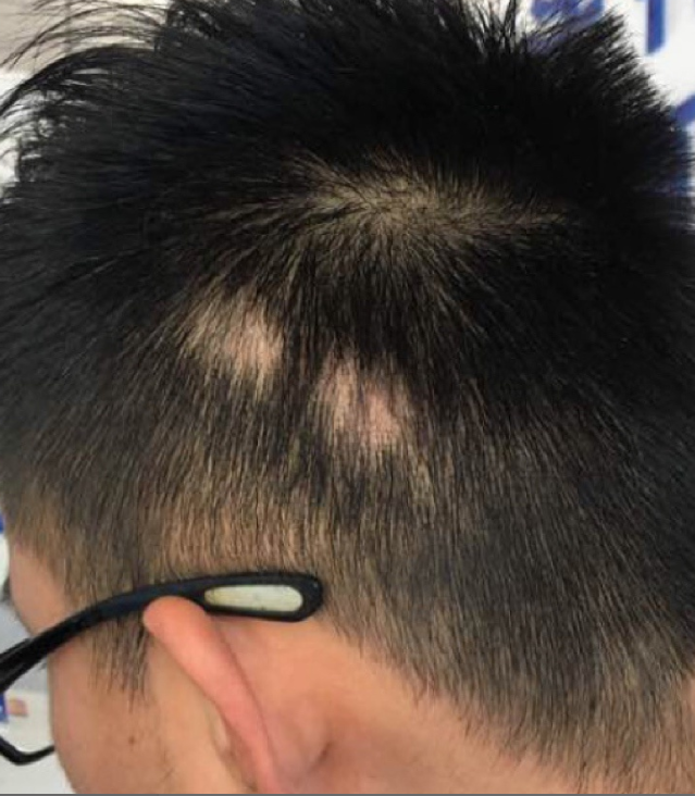 滋森漫斑秃治疗恢复过程需要注意什么斑秃养护须知