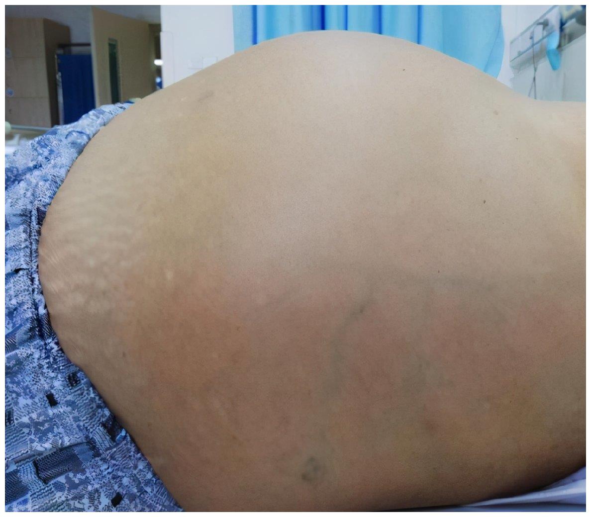 肝硬化晚期的"四大信号",医生:大部分人都会中招,要小心|肝硬化|症状