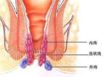 北京东大肛肠医院科普：新妈妈如何预防产后痔疮？
