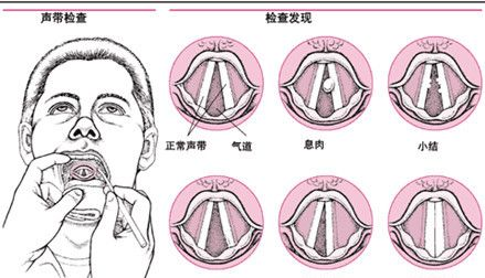 声带受损声音嘶哑怎么办,声带受损声音嘶哑怎么处理