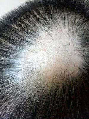 滋森漫斑秃治疗恢复过程需要注意什么斑秃养护须知