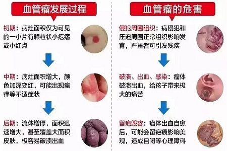 婴儿血管瘤是怎样形成的?