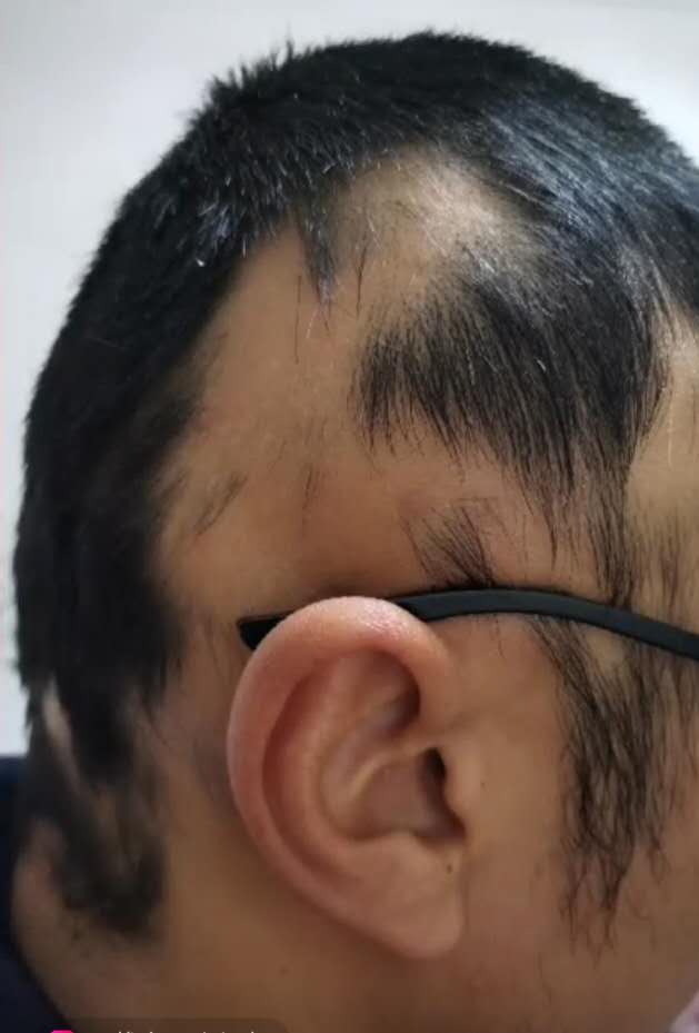 滋森漫斑秃治疗恢复过程需要注意什么斑秃养护须知