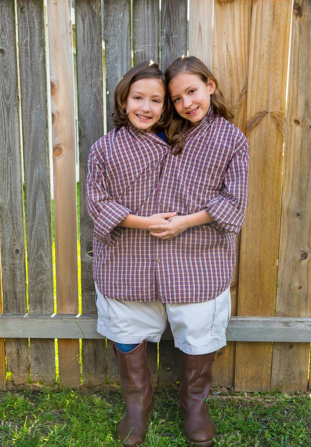 诞生了一对男性连体婴,他们的父亲是中国人,母亲则是泰华混血儿,这对