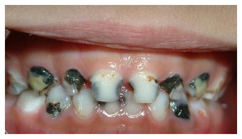 4岁女童满口"黑牙",奶奶带孩子去看牙医,医生:不是糖的锅