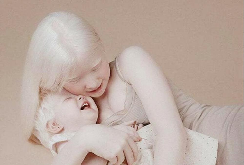 她们是一对姐妹,名叫asel和kamila,出生便患有白化病,因此她们一生下