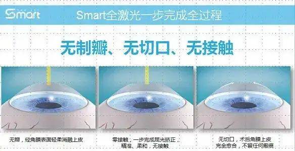 眼科设备销售怎么样郑州卓美眼科：解析阿玛仕1050Rs设备Smart全激光_https://www.jmylbn.com_新闻资讯_第9张