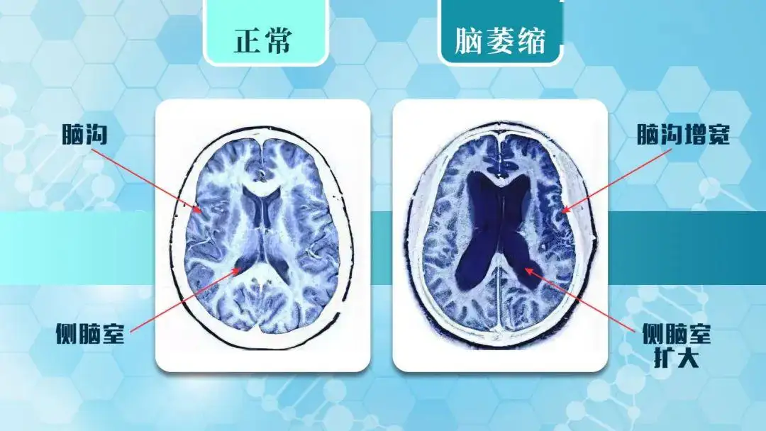 如何治疗小脑萎缩 预防小脑萎缩的方法