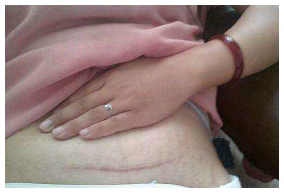 剖腹产产妇不听婆婆话,导致伤口溃烂,看到伤口医生立马安排手术