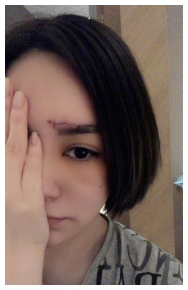 阿娇首晒清晰伤口照!伤至眉心眉毛都变形,引众人担心毁容留疤