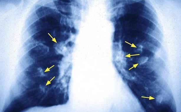 肺癌到來時，睡覺會出現5個異常，若發現請及時就診！