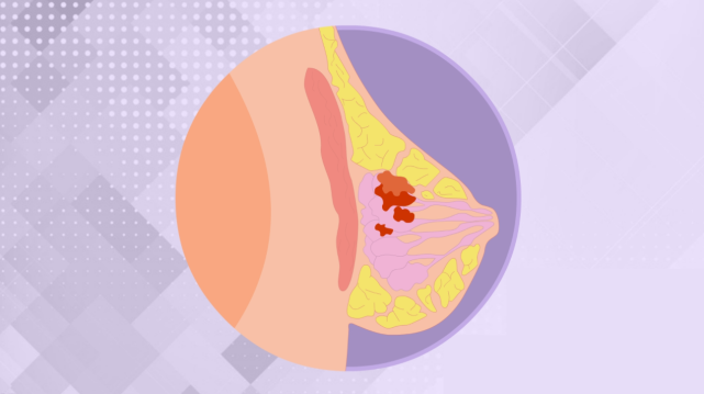 乳腺|肿块|乳腺癌_新浪新闻