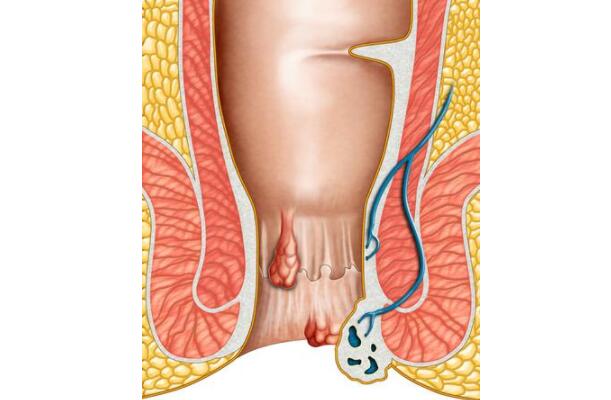 夏季肛门周围很痒,是天热闹的?医生:当心5种疾病缠上身