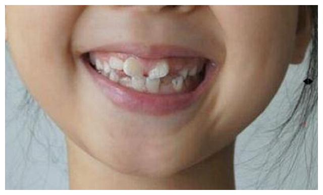 孩子长了双排牙乳牙滞留乳牙迟迟不脱落影响宝宝口腔健康