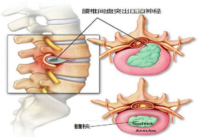 睡硬板床能治好腰间盘突出