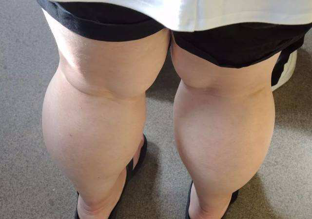 大肚子的你有没有想过,肥胖可能导致脑萎缩?