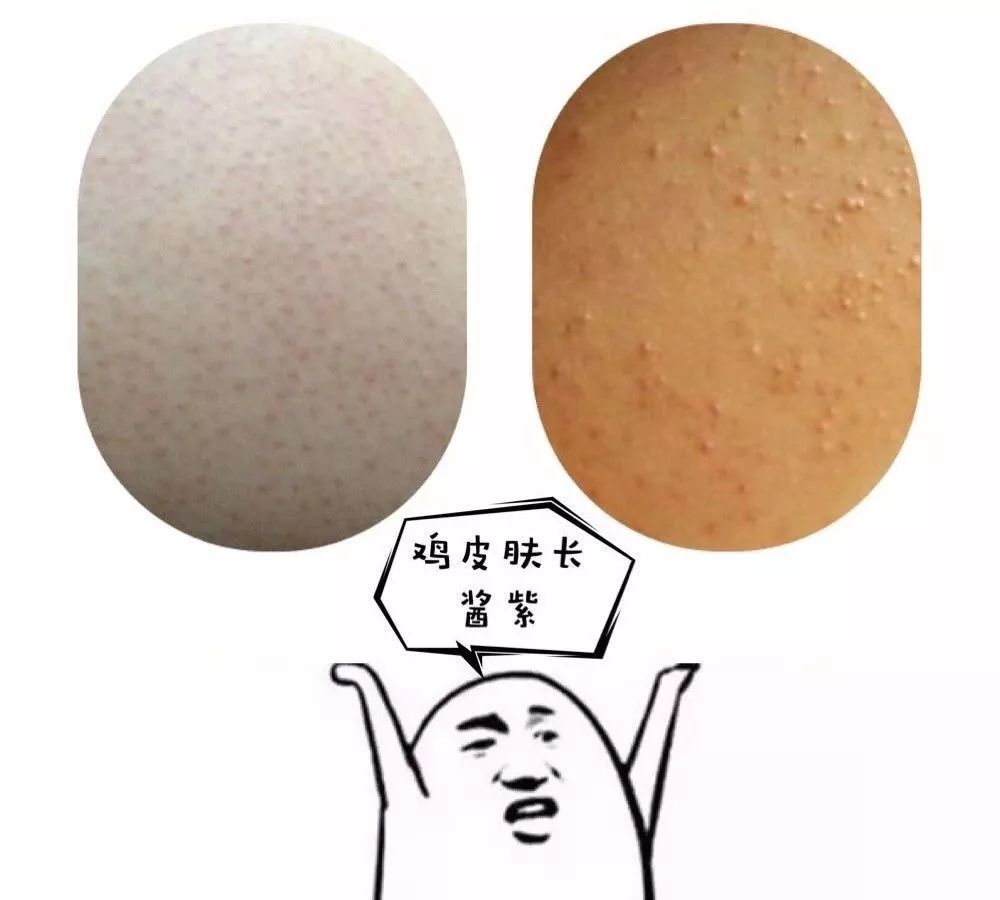 鸡皮肤超严重(鸡皮肤非常严重)