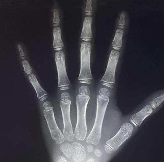 孩子一直长不高让人愁,可以做这个,不让孩子错过长高敏感期|骨龄|发育