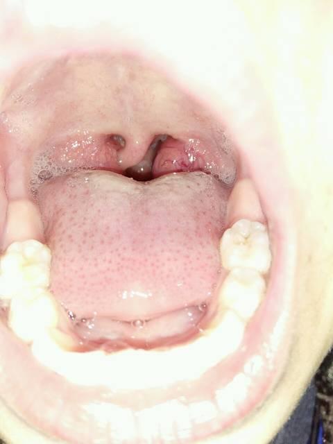 扁桃体肥大用灼烙可以治疗吗手术以及灼烙到底哪个更安全