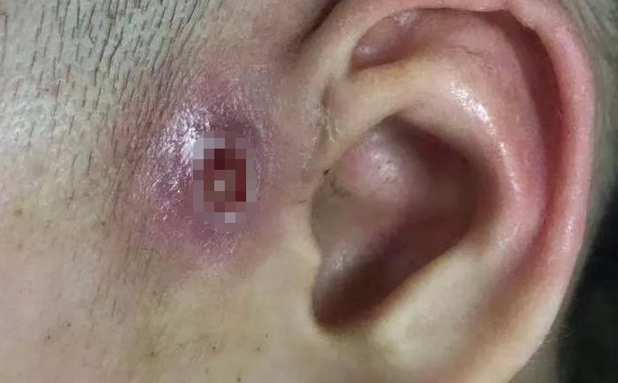 爸妈要心里有数|瘘管|耳朵|手术_新浪新闻