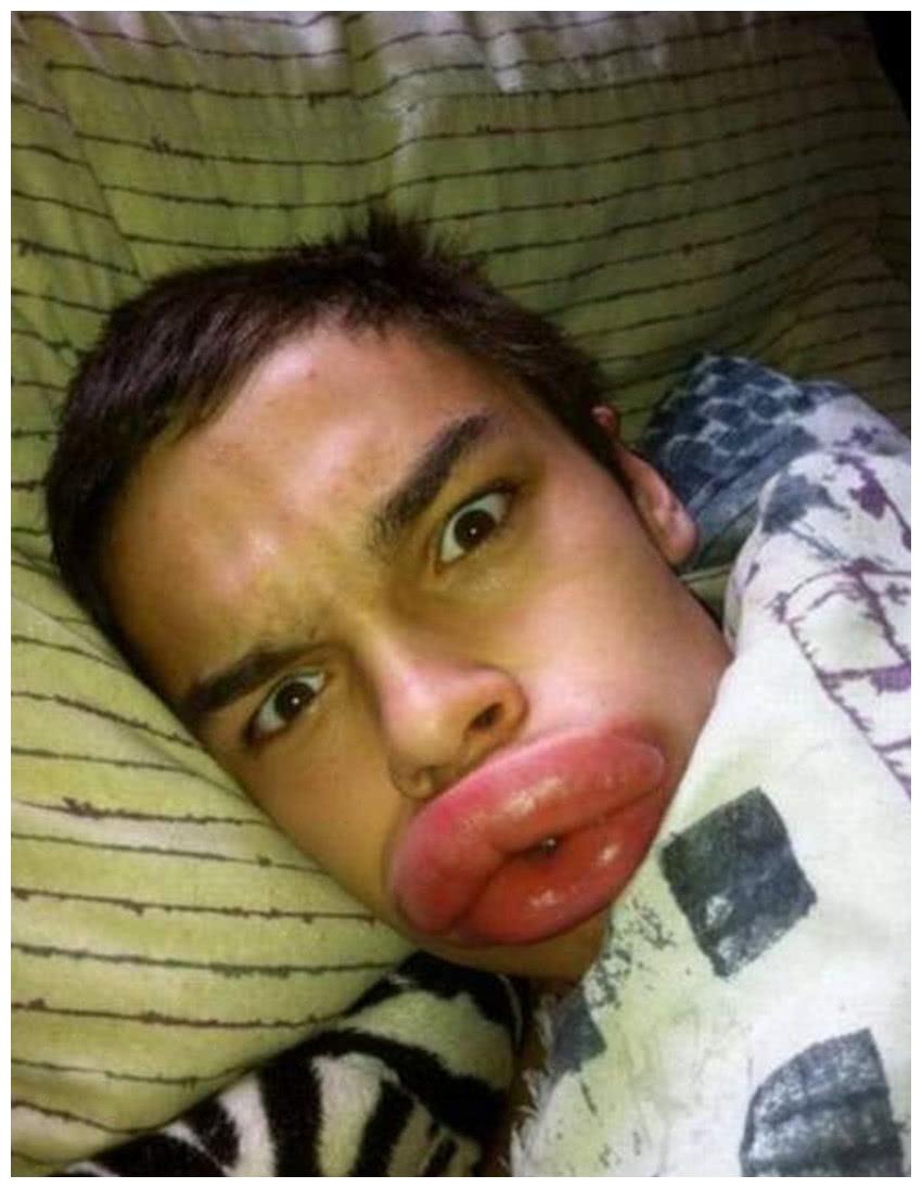 被蜜蜂"亲吻"后的香肠嘴, 从他们的眼里我看到了绝望