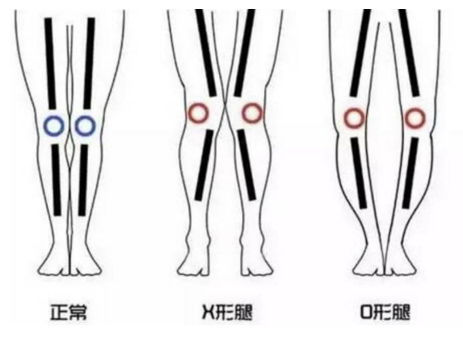 足部畸形影响孩​子的一生，花1分钟自测中招没休闲区蓝鸢梦想 - Www.slyday.coM