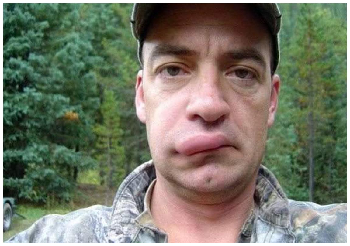 被蜜蜂"亲吻"后的香肠嘴, 从他们的眼里我看到了绝望