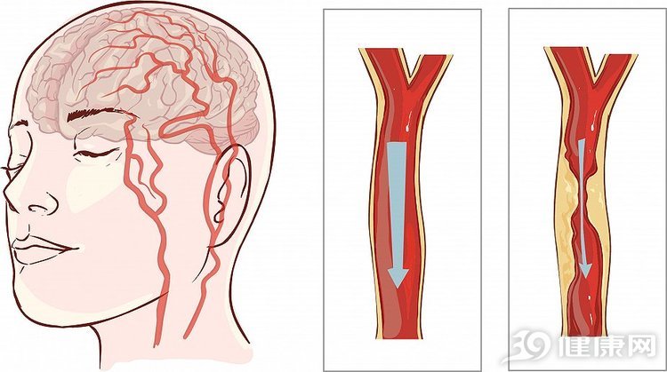65岁男子突发中风,医生:身体出现5种症状,第一时间打120休闲区蓝鸢梦想 - Www.slyday.coM 65岁男子突发中风,医生:身体出现5种症状,第一时间打120休闲区蓝鸢梦想 - Www.slyday.coM