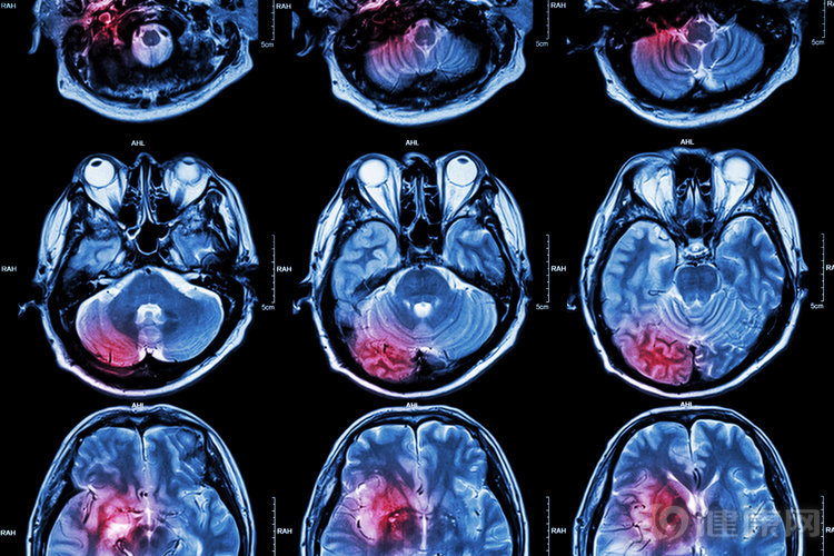 65岁男子突发中风,医生:身体出现5种症状,第一时间打120休闲区蓝鸢梦想 - Www.slyday.coM 65岁男子突发中风,医生:身体出现5种症状,第一时间打120休闲区蓝鸢梦想 - Www.slyday.coM